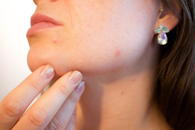 Acne volwassene