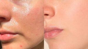 Gezichtsbehandeling huidpraktijk ilp before after
