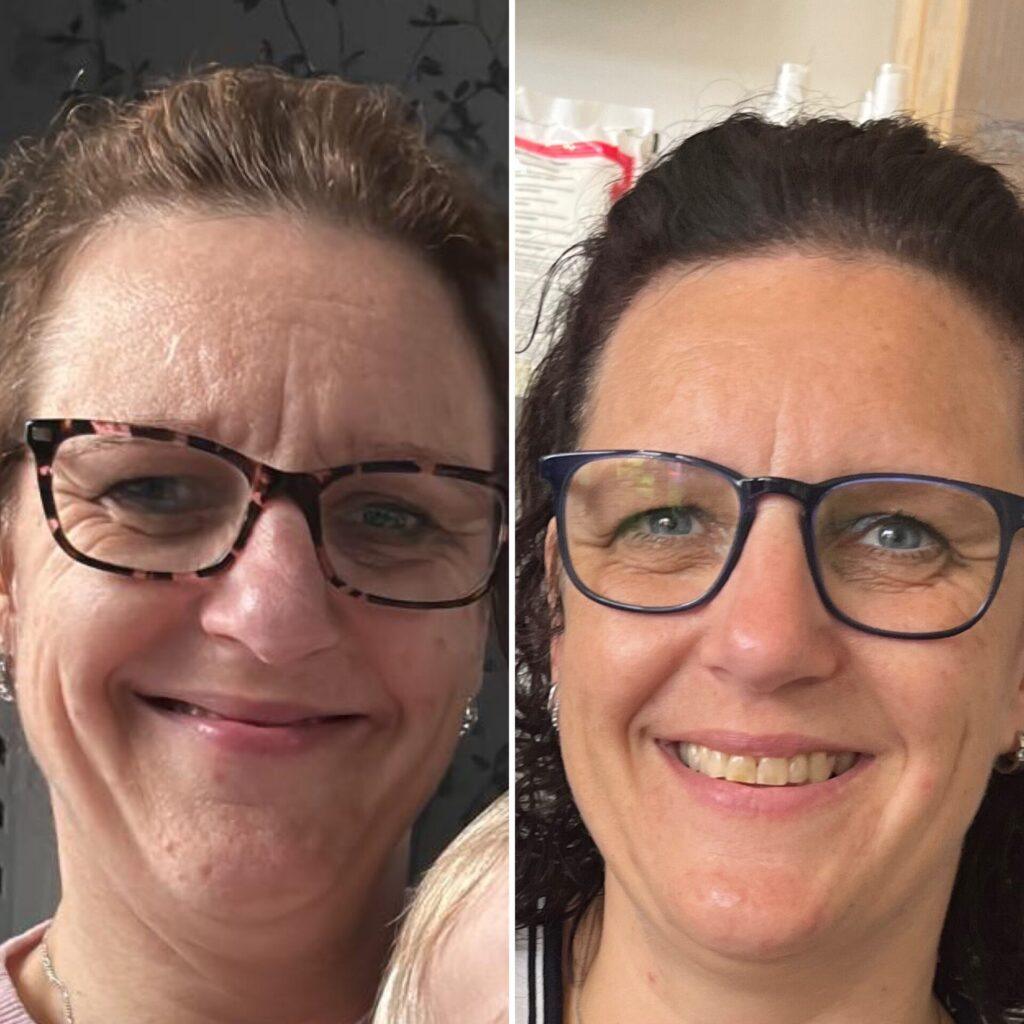 Hydrafacial microdermabrasie before after