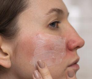 Rosacea droge huid