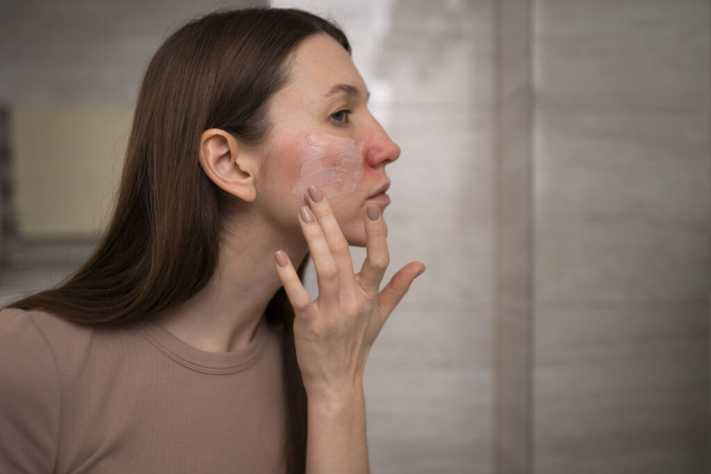 Rosacea droge huid