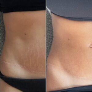 Striae behandeling before after