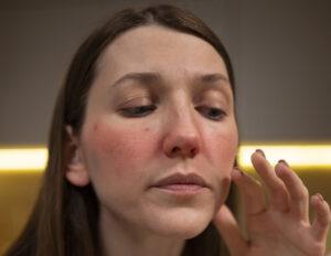 rosacea roodheid