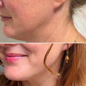 Hifu before after huidpraktijk ilp