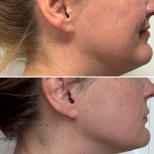 Hifu-behandeling before after huidpraktijk ilp