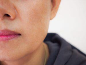Melasma after huidpraktijk ilp
