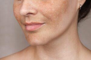 Melasma behandeling huidpraktijk ilp