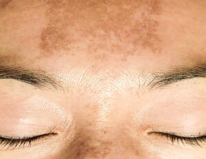 Melasma op voorhoofd
