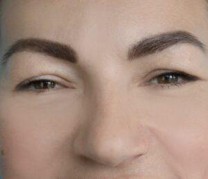 Microneedling after, huidpraktijk ilp