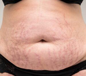 Striae buik