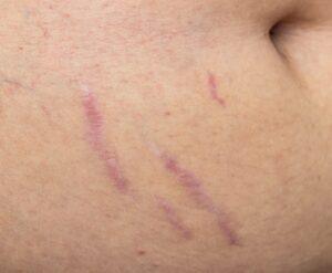 Striae paars rood