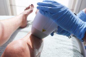 laserontharing onderbeen