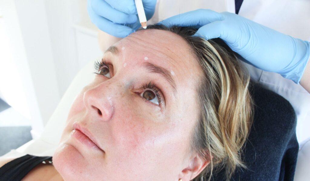 Botox behandeling