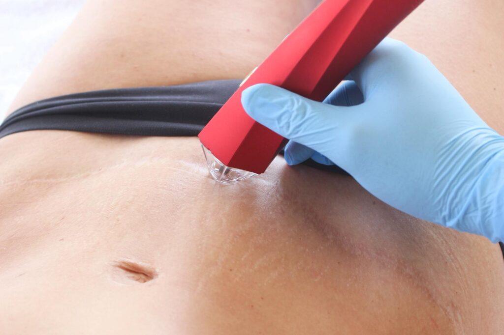 Buikwandcorrectie-litteken cold plasma