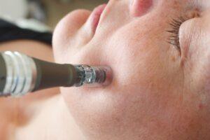 Microneedling op wang