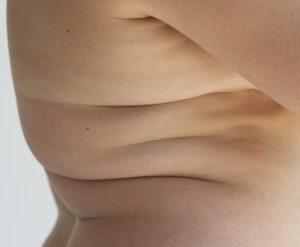 Overgewicht en obesitas