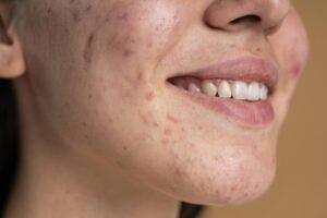puistjes en acne