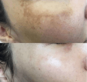 BioRePeel melasma