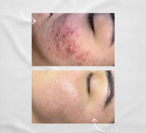 BioRePeel acne