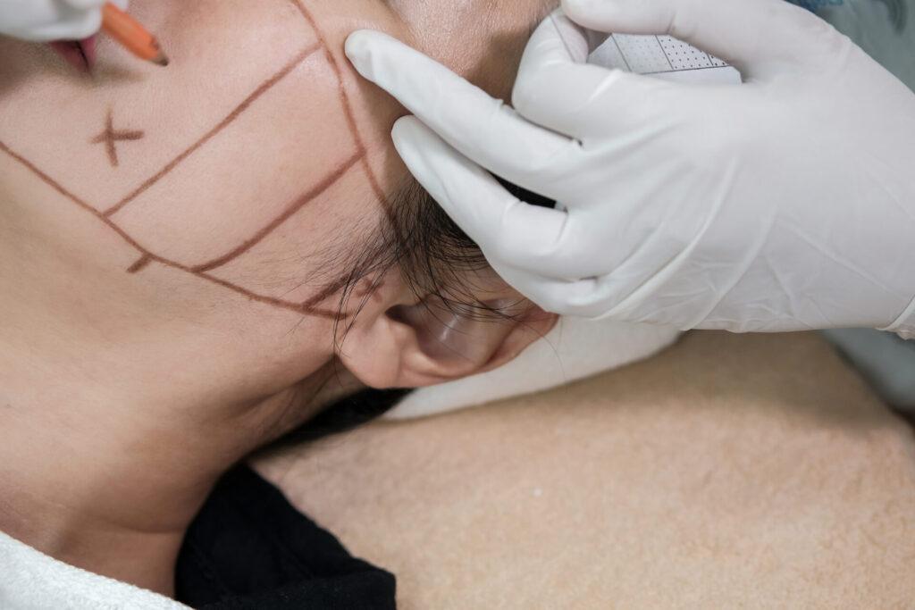 Hifu behandeling Amsterdam