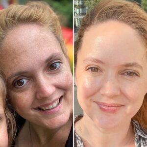 Melasma-behandeling before after huidpraktijk ilp