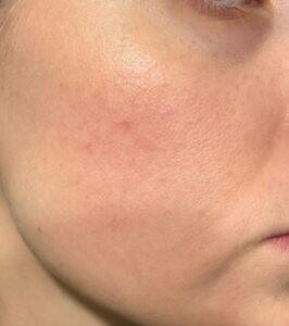 Tretinoine-behandeling after