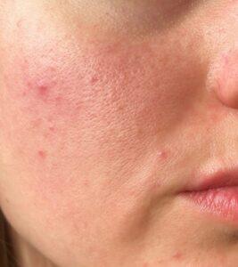 Tretinoine behandeling before