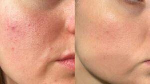 Tretinoine creme before after