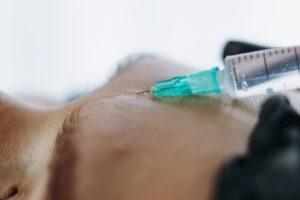 Profhilo-behandeling bij Huidpraktijk ilp