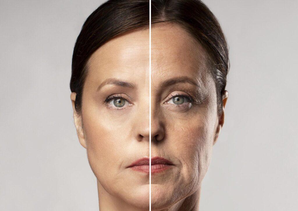 Slappe huid before after