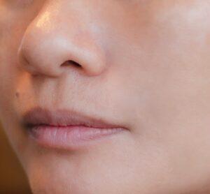 Fillers after